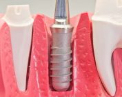 dental-implant-in-houston-177x142