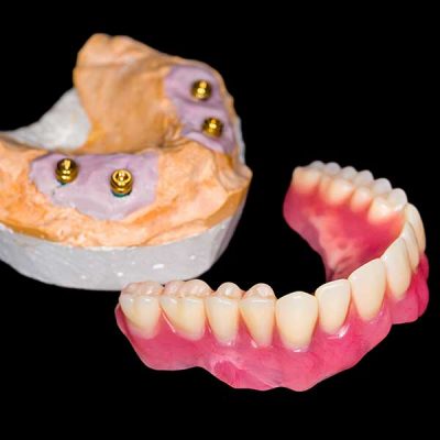 houston-denture-implant-400x400